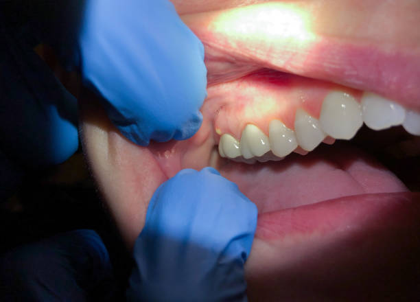 Best Emergency Dental Care for Broken or Chipped Teeth in Woodville, WI